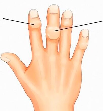 Ganglionii Heberden și Bouchard pe articulațiile interfalangiene cu artroză