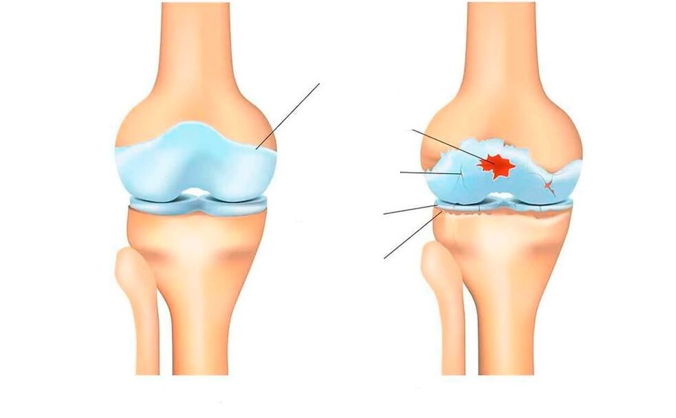 articulație sănătoasă și cu artroză