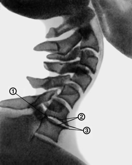 Radiografia coloanei cervicale cu osteocondroză