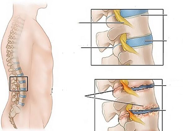 modificări ale discurilor din cauza osteocondrozei