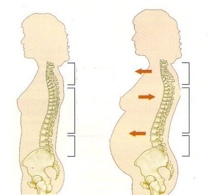 osteocondroza în timpul sarcinii