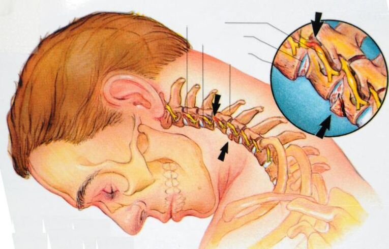 simptome de osteocondroză cervicală